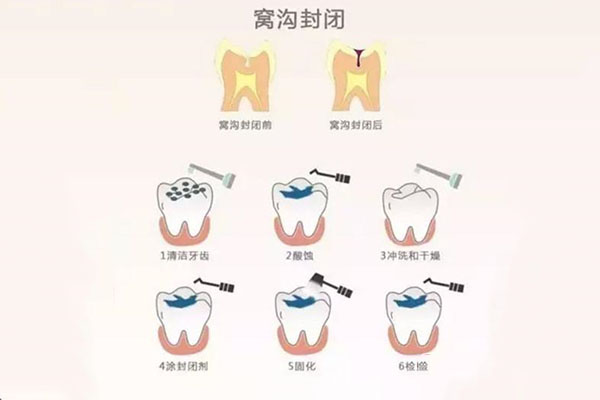 乳牙需要封窝沟吗(乳牙需要封窝沟吗
