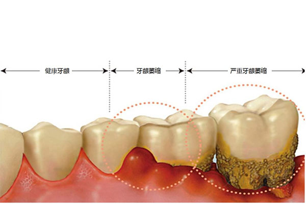 中医治疗牙齿松动牙龈萎缩的中医专家是什么(中医治疗牙齿松动牙龈萎缩的中