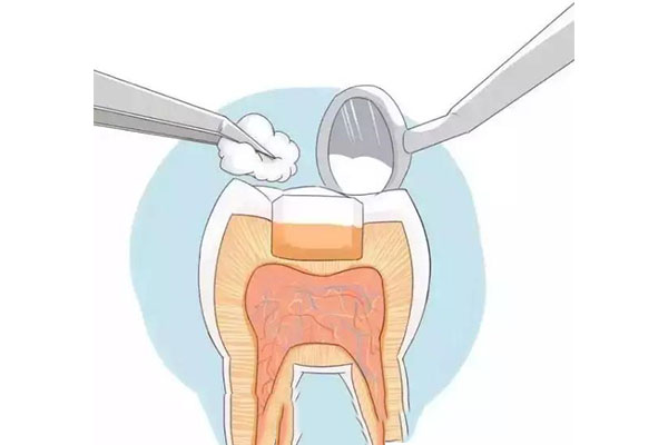 上牙怎么补牙好(上牙怎么补牙好看)