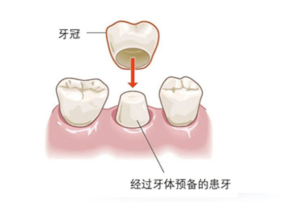 乳牙补牙材料哪种好用点(乳牙补牙用什么材料最好)