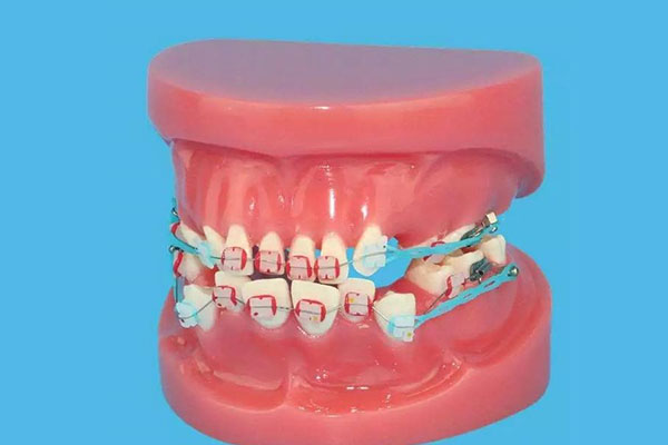全瓷和烤瓷牙有什么区别(全瓷和烤瓷