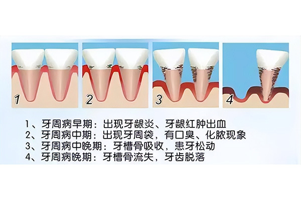 轻微牙周炎怎么治疗效果好一点(轻微