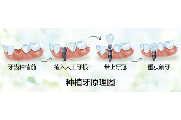 亮贝美口腔医院种植牙齿怎么样(亮贝美牙科医院)