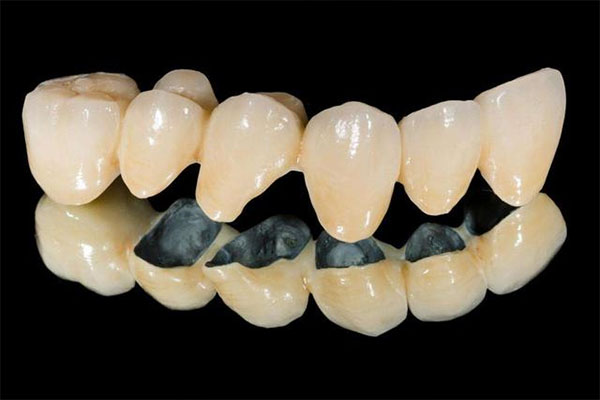 全瓷牙冠最低多少钱(全瓷牙冠最低多