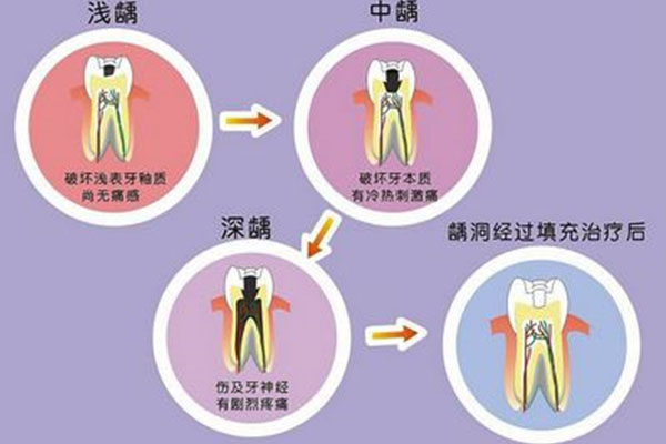 5岁儿童蛀牙牙痛怎么办(5岁儿童蛀牙