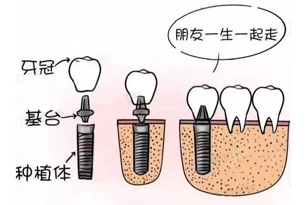 东营市人民医院种牙多少钱(东营种牙