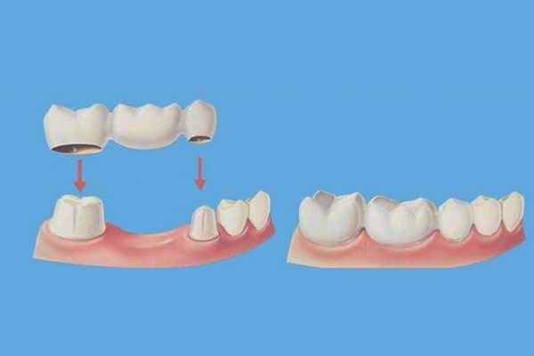 全瓷冠与烤瓷牙的区别(全瓷冠与烤瓷