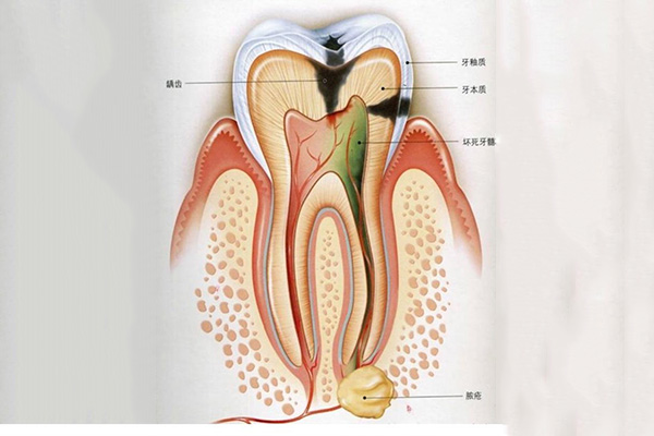 乳牙拔牙后的注意事项是什么(乳牙拔