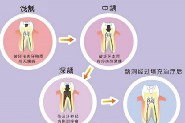 7岁儿童龋齿不治可以吗(7岁儿童龋齿不治可以吗图片)