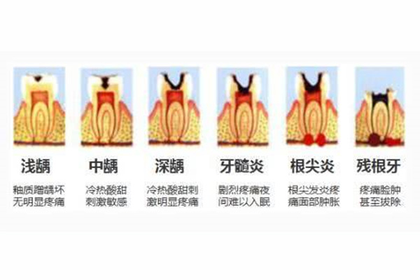 6岁儿童蛀牙怎么办(6岁儿童蛀牙怎么