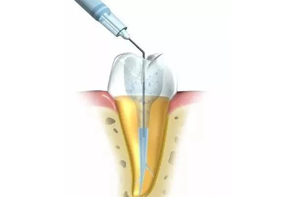 什是根管治疗