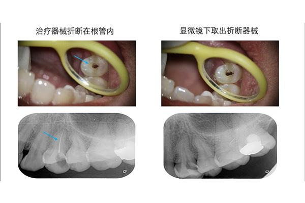 做了根管治疗的牙齿可以用多久(做了根管治疗的牙齿可以用多久