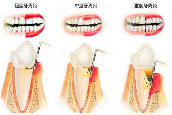 轻微牙周炎有什么症状表现(轻微牙周