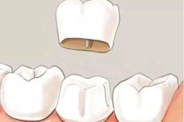为什么补牙后牙龈化脓(补牙后牙龈化