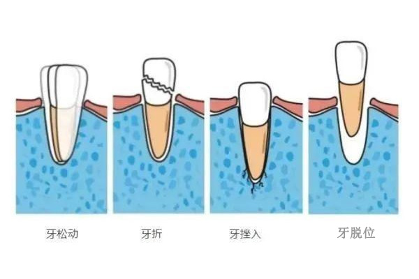中年人牙齿松动脱落是什么病引起的(中年人牙齿松动脱落是什么