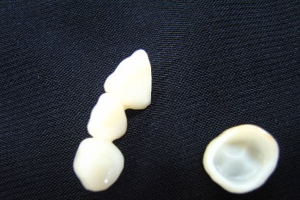 全瓷牙牙冠价格表(全瓷牙冠价目表)
