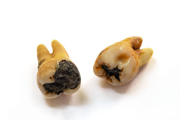 去医院拔智齿好还是去牙科诊所拔好
