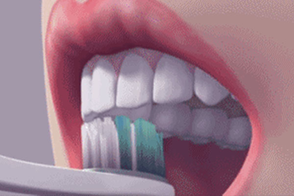 洁牙后抛光的重要性是什么(洁牙后抛