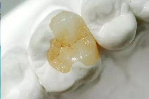 乳牙根尖周炎治疗一例多少次(乳牙根尖周炎治疗一例多少次能好