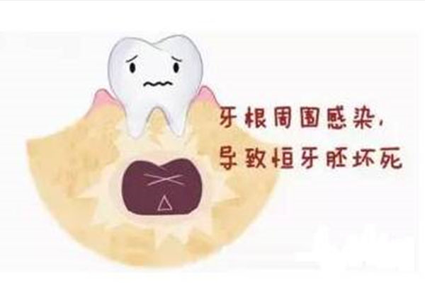 5岁龋齿非常严重(5岁龋齿非常严重怎