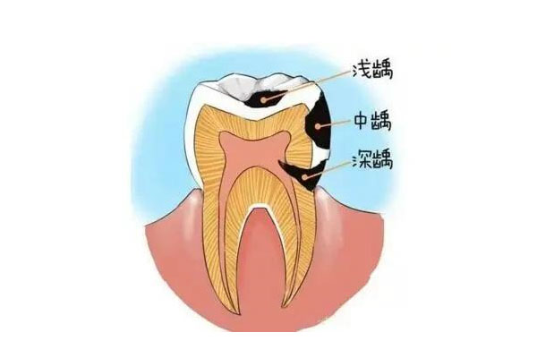 7岁小朋友后槽牙蛀牙一个洞(7岁小朋友后槽牙蛀牙一个洞是乳牙