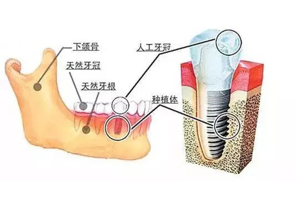 什么情况下不能种植牙齿国内三甲医