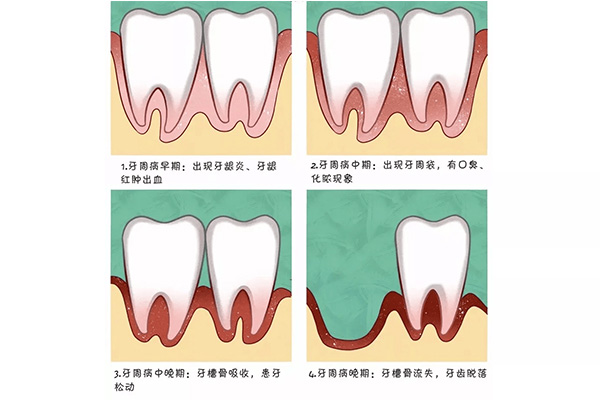 重度牙周炎表现(重度牙周炎表现有哪
