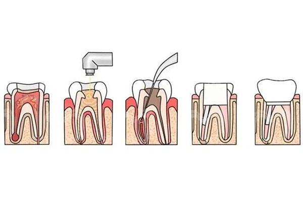 什么叫根管治疗牙疼症状(什么叫根管