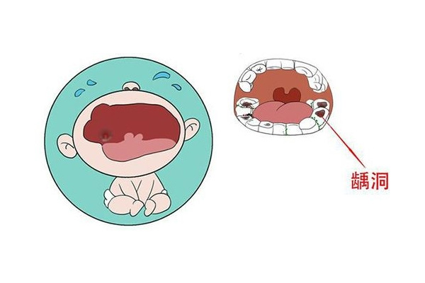 小孩拔蛀牙要多少钱呢