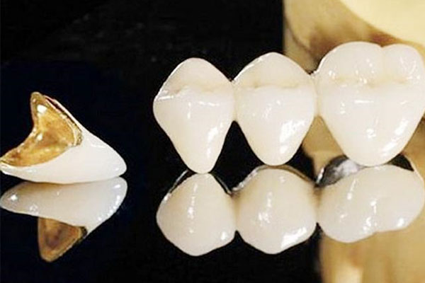 威兰德全瓷牙冠可以用多久(威兰德全瓷牙冠可以用多久呢)
