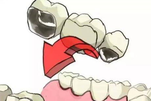 安装了烤瓷牙后牙齿痛(装了烤瓷牙后