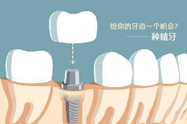 北京口腔医院种牙多少钱一颗啊(北京口腔医院种牙多少钱一颗啊