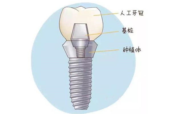 全口种牙优缺点及优点(全口种牙优缺