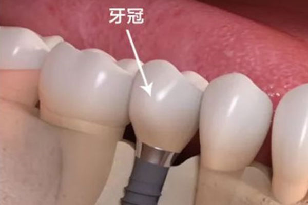 补牙和种牙有区别吗？中老年口腔专
