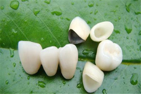 牙冠和瓷贴面哪个好(瓷贴面和牙冠牙