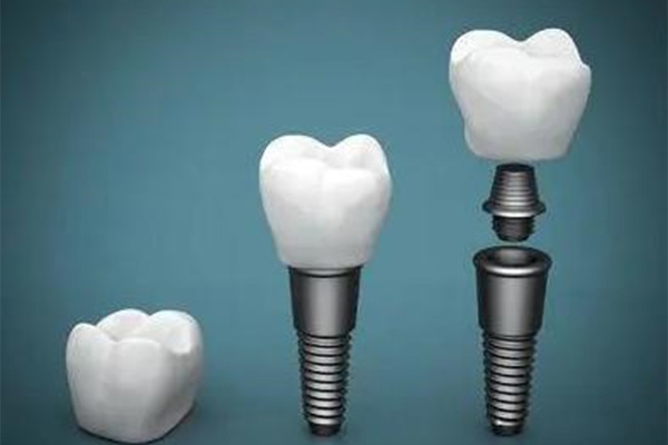 种牙医保能报销多少？中老年缺牙患