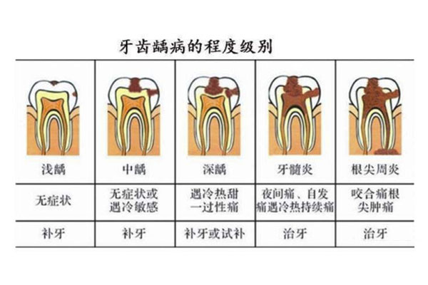 蛀牙初期会牙疼吗 中老年口腔提醒别忽视这些小信号