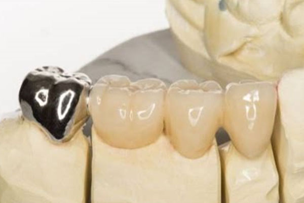金属假牙手术可行吗？费用多少？中
