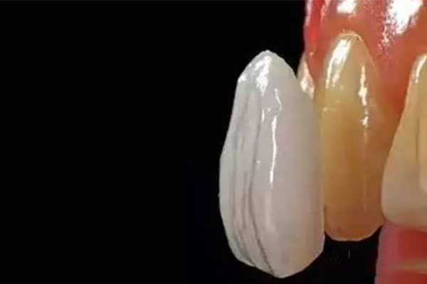 牙瓷贴面有几种材料组成(牙瓷贴面有