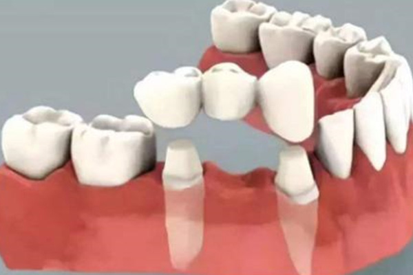 全瓷牙套和烤瓷牙套价格一样吗(全瓷