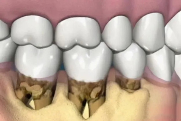 对牙龈萎缩有什么特效药治疗好(有什么治疗牙龈萎缩的药)