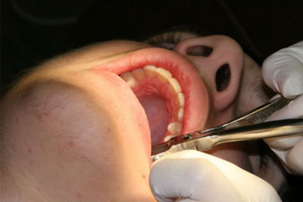 小孩牙根尖炎能自愈吗怎么治疗(小孩牙根尖炎能自愈吗怎么治疗