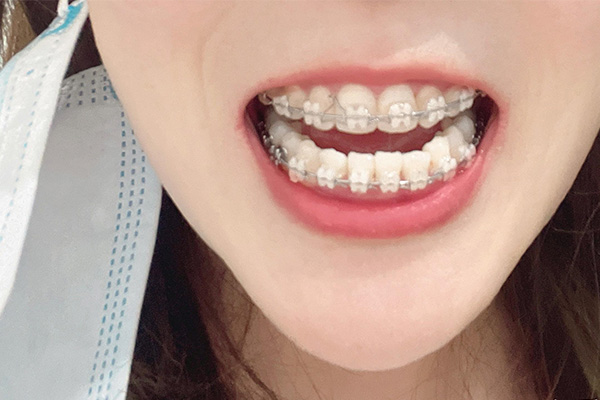 牙齿黄是色素吗(牙齿黄是色素吗怎么调理)