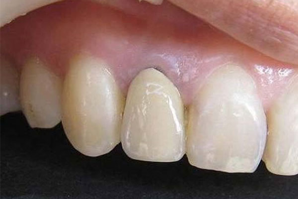 年轻人牙龈萎缩严重和体质有关吗怎么治疗好(年轻人牙龈萎缩严