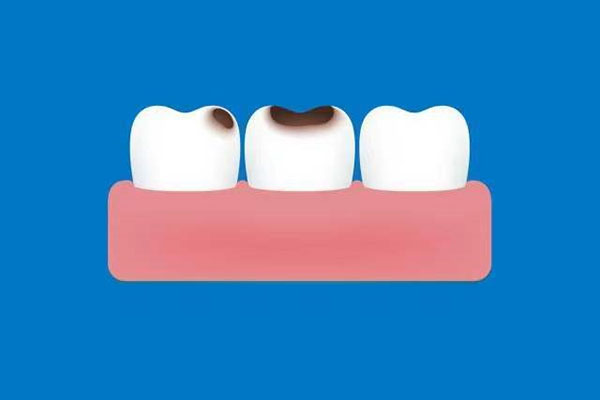 两岁半蛀牙要补牙吗(两岁半蛀牙要补牙吗多少钱)