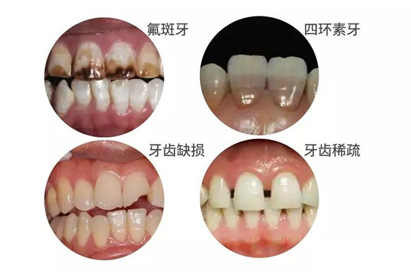 牙齿黑色素沉着如何去除最快(牙齿黑