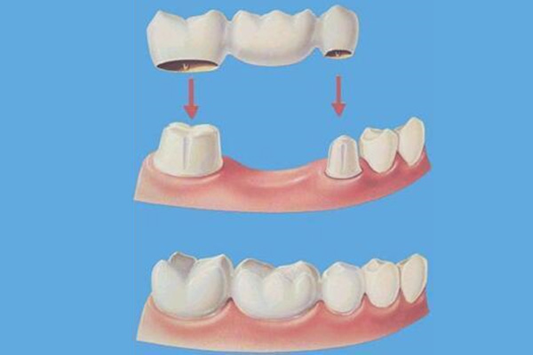 儿童牙齿脱矿如何补救吃什么药好使