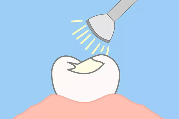 医保洗牙能报销吗(医保洗牙能报销吗)