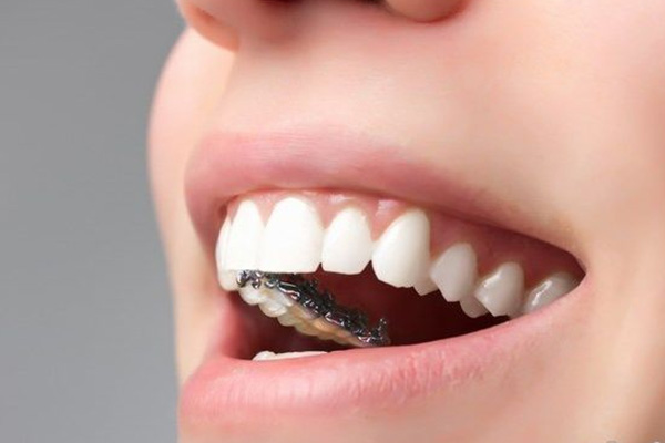 牙齿色素沉着能刷掉吗怎么治疗好得快(牙齿色素沉着能刷掉吗怎