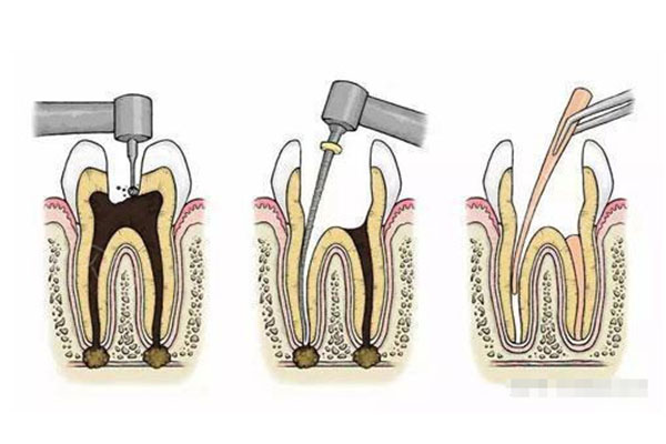 做过根管的牙多少钱一颗(做过根管的